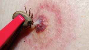 Вкусив кліщ: чи потрібно заливати його олією, викручувати і возити на аналіз