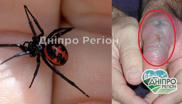 У Дніпрі чоловіка вкусив павук, отрута якого в 15 разів сильніша, ніж у гримучої змії (ФОТО) У Дніпрі чоловіка вкусив павук, отрута якого в 15 разів сильніша, ніж у гримучої змії (ФОТО)