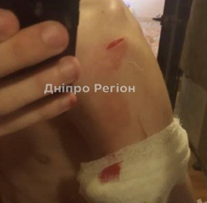 У Дніпрі біля магазину АТБ хлопчик порізався об кондиціонер: рану зашивали медики (ФОТО)