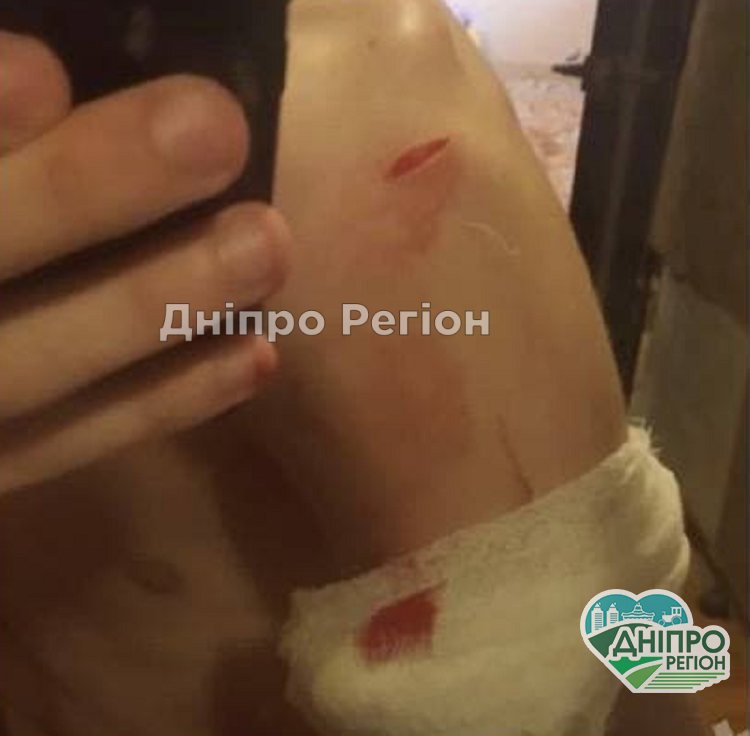 У Дніпрі біля магазину АТБ хлопчик порізався об кондиціонер: рану зашивали медики (ФОТО) У Дніпрі біля магазину АТБ хлопчик порізався об кондиціонер: рану зашивали медики (ФОТО)