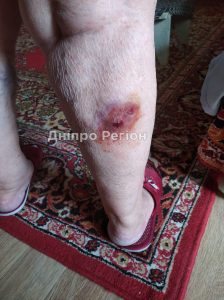 У Дніпрі бездомна собака покусала літню жінку, яка стояла на зупинці маршрутки (ФОТО)