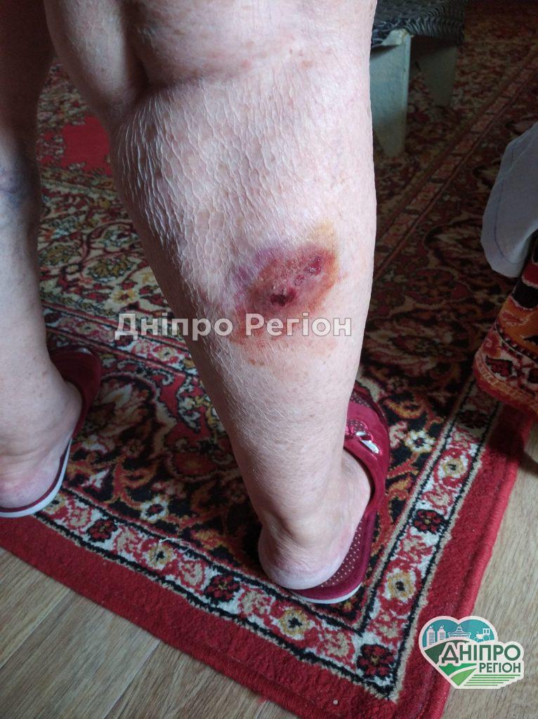 Рвана рана і куча проблем: у Дніпрі на Лівому березі бездомна собака вкусила пенсіонерку