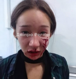 Все селище боїться за дітей: під Дніпром собака покусала школярку за обличчя