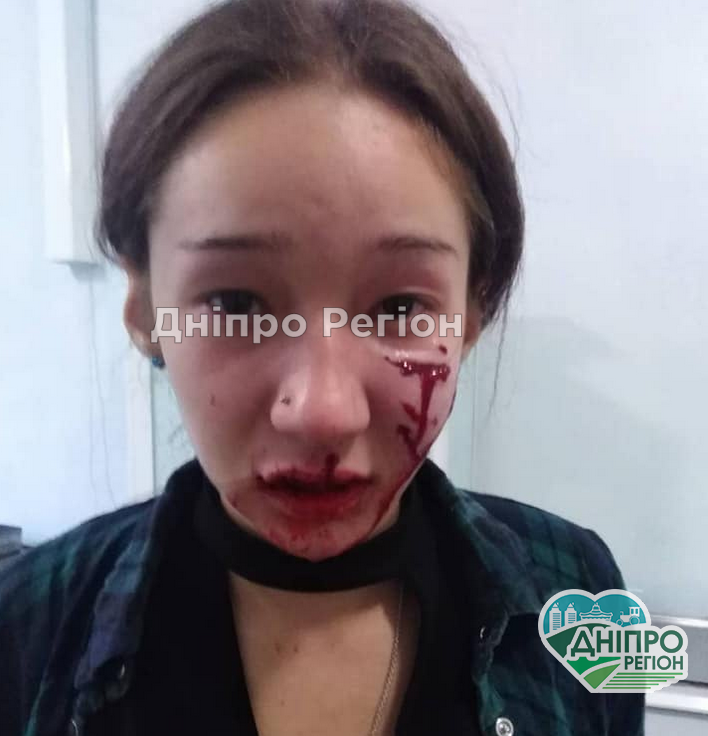 Все селище боїться за дітей: під Дніпром собака покусала школярку за обличчя Пес зірвався із прив'язі і покусав школярку: у Дніпрі прооперували дівчину, на обліччі можуть залишитись шрами