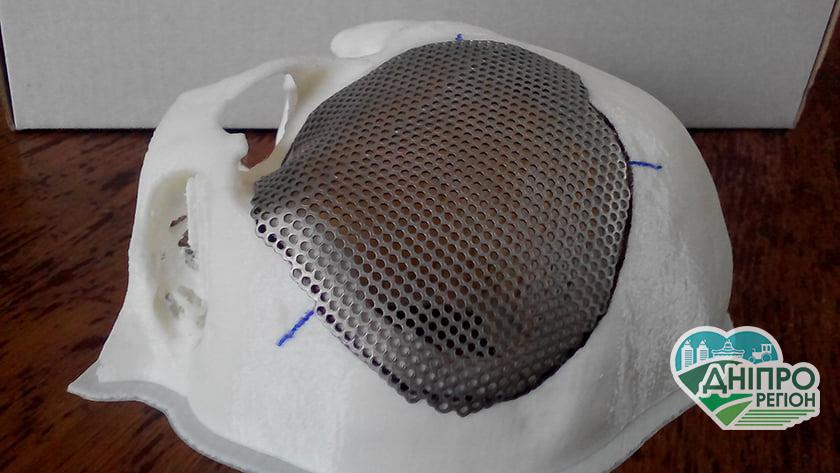 У Дніпрі врятували життя 10-річному хлопцю після ДТП: вставили титанову пластину в голову У Дніпрі врятували життя 10-річному хлопцю після ДТП: вставили титанову пластину в голову