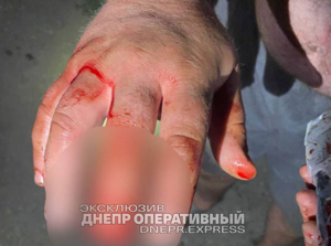 Поговорили: у Дніпрі чоловіку його друг відкусив середній палець