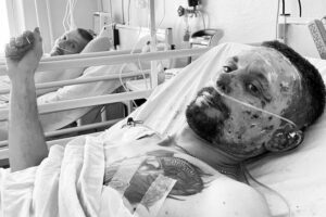 Тричі вдалося вижити, коли смерть забирала усіх побратимів: у Дніпрі рятують відважного захисника