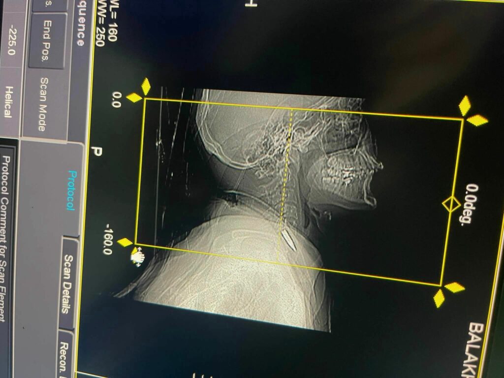 У Дніпрі врятували військового, у якого куля пройшла через руку, грудну клітку та зупинилася в шиї