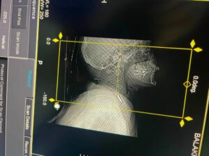 У Дніпрі врятували військового, у якого куля пройшла через руку, грудну клітку та зупинилася в шиї