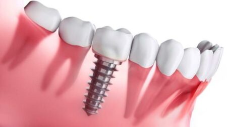 Показання до імплантації зубів: в яких випадках її необхідно робити