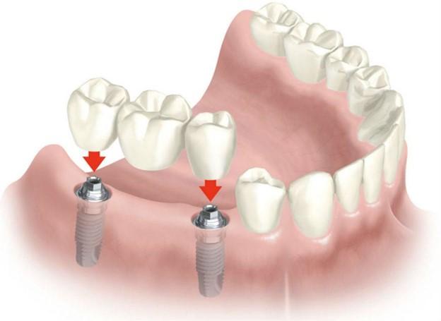 Показання до імплантації зубів: в яких випадках її необхідно робити