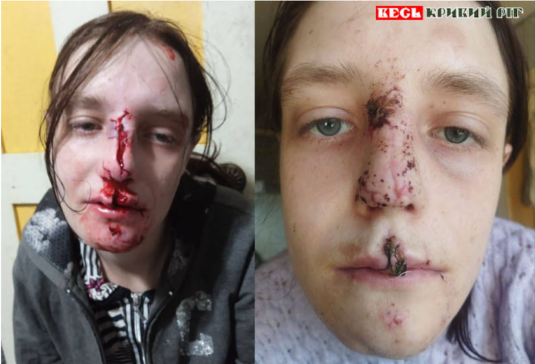 На Дніпропетровщині вівчарка розірвала обличчя дівчині під час стріму в TikTok